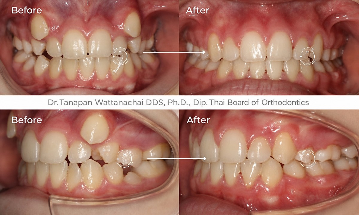 Resultados antes y después de Invisalign en Empress Dental: alineación dental y sonrisa mejoradas
