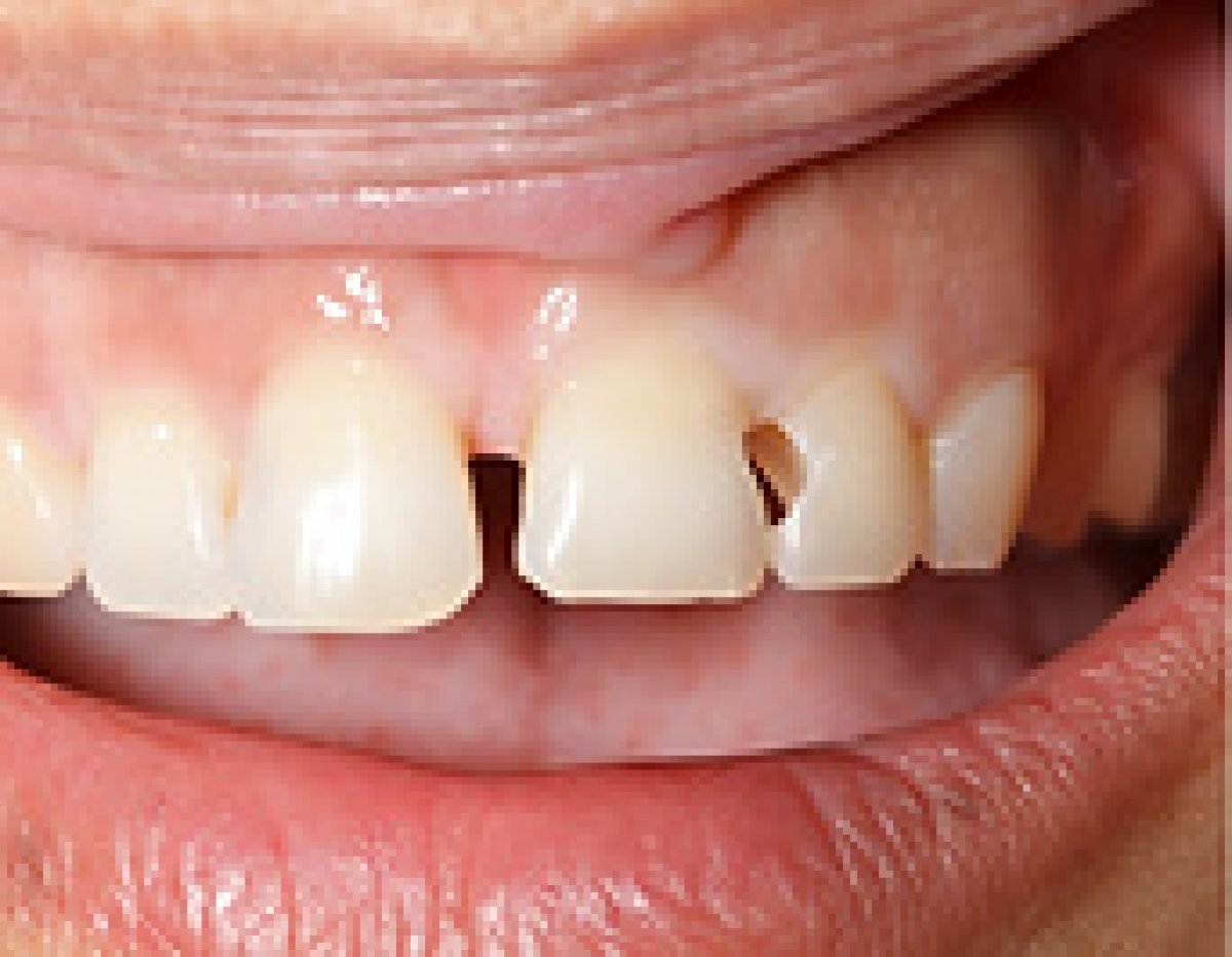 Antes del tratamiento de caries en Empress Dental, daño dental visible
