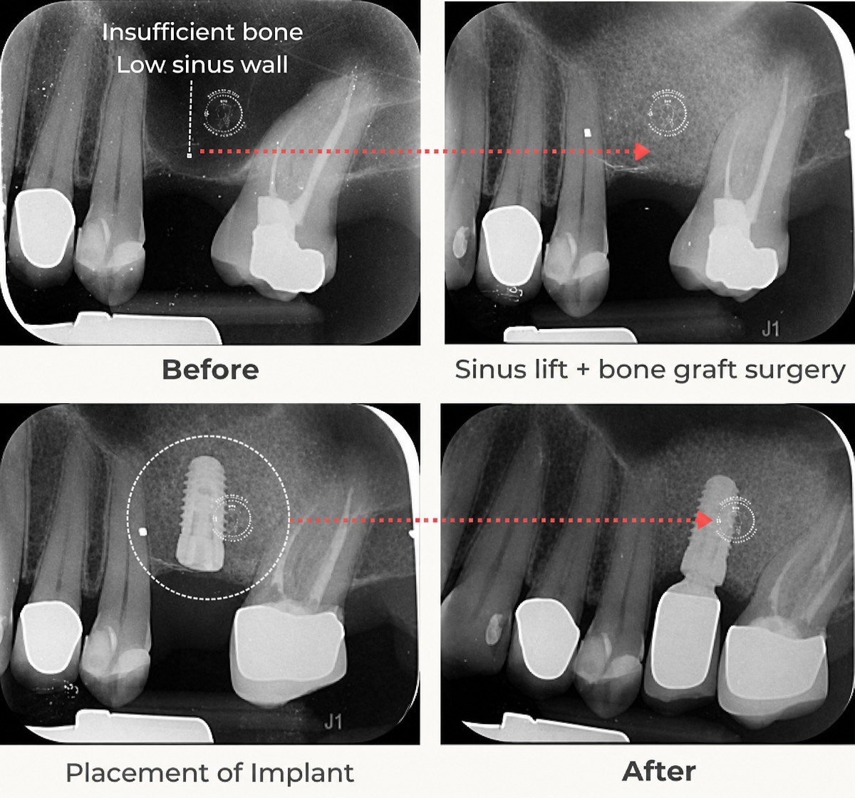 До и после имплантации зуба с синус-лифтингом и костной пластикой в Empress Dental, результат