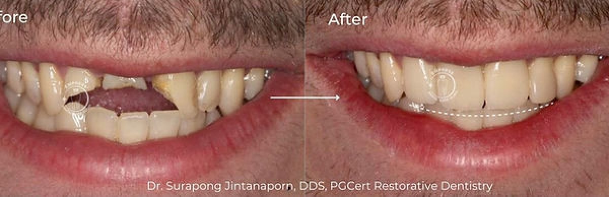 Antes y después de la colocación de coronas dentales en Empress Dental – sonrisa restaurada