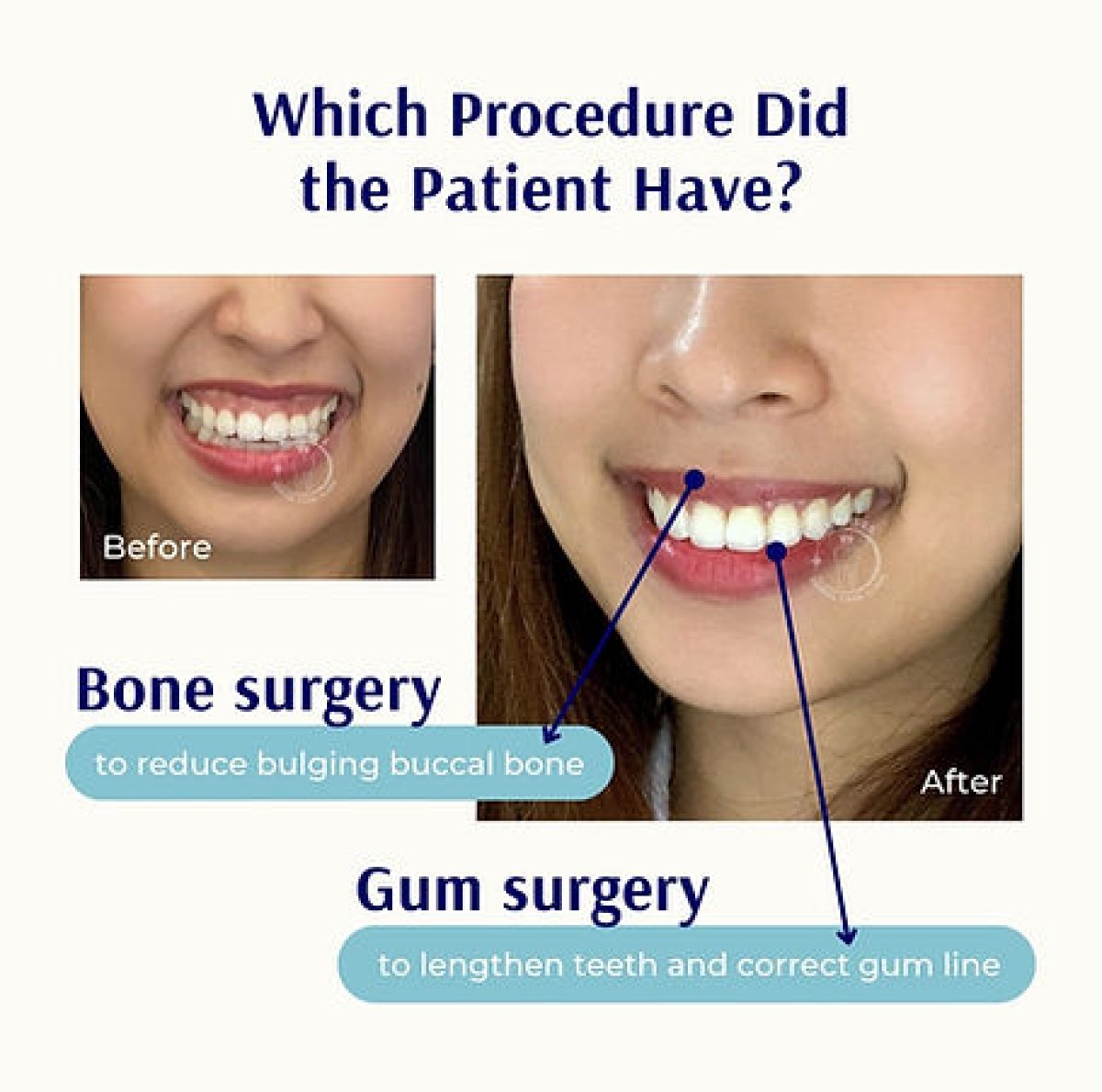 Antes y después de cirugía de encías en Empress Dental – línea de encías mejorada y dientes más largos