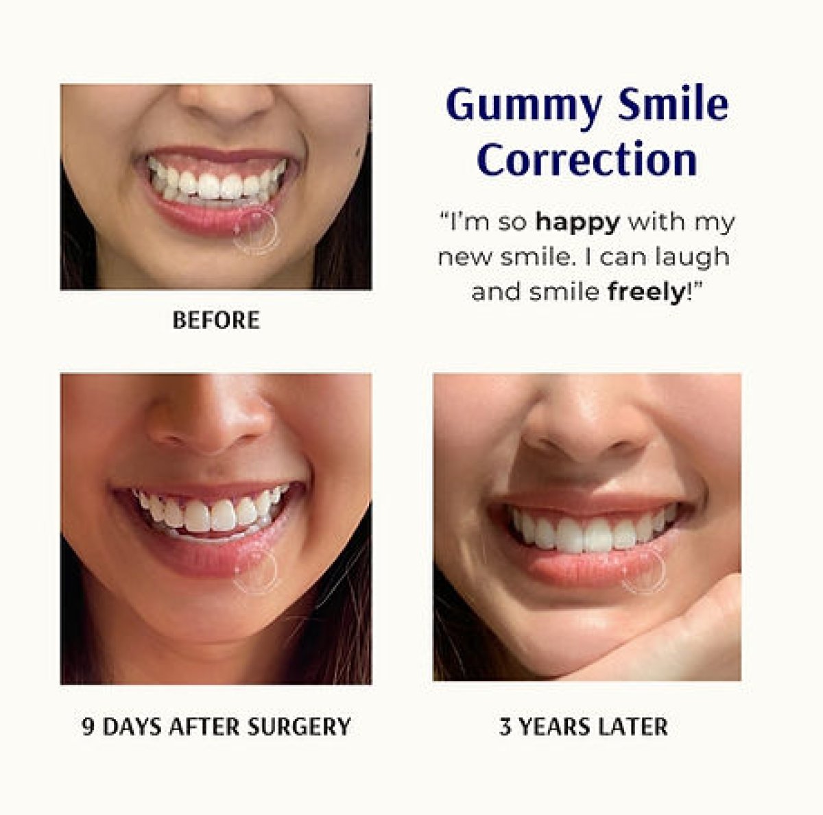 Resultados de cirugía de encías antes y después en Empress Dental: sonrisa con menos encía visible