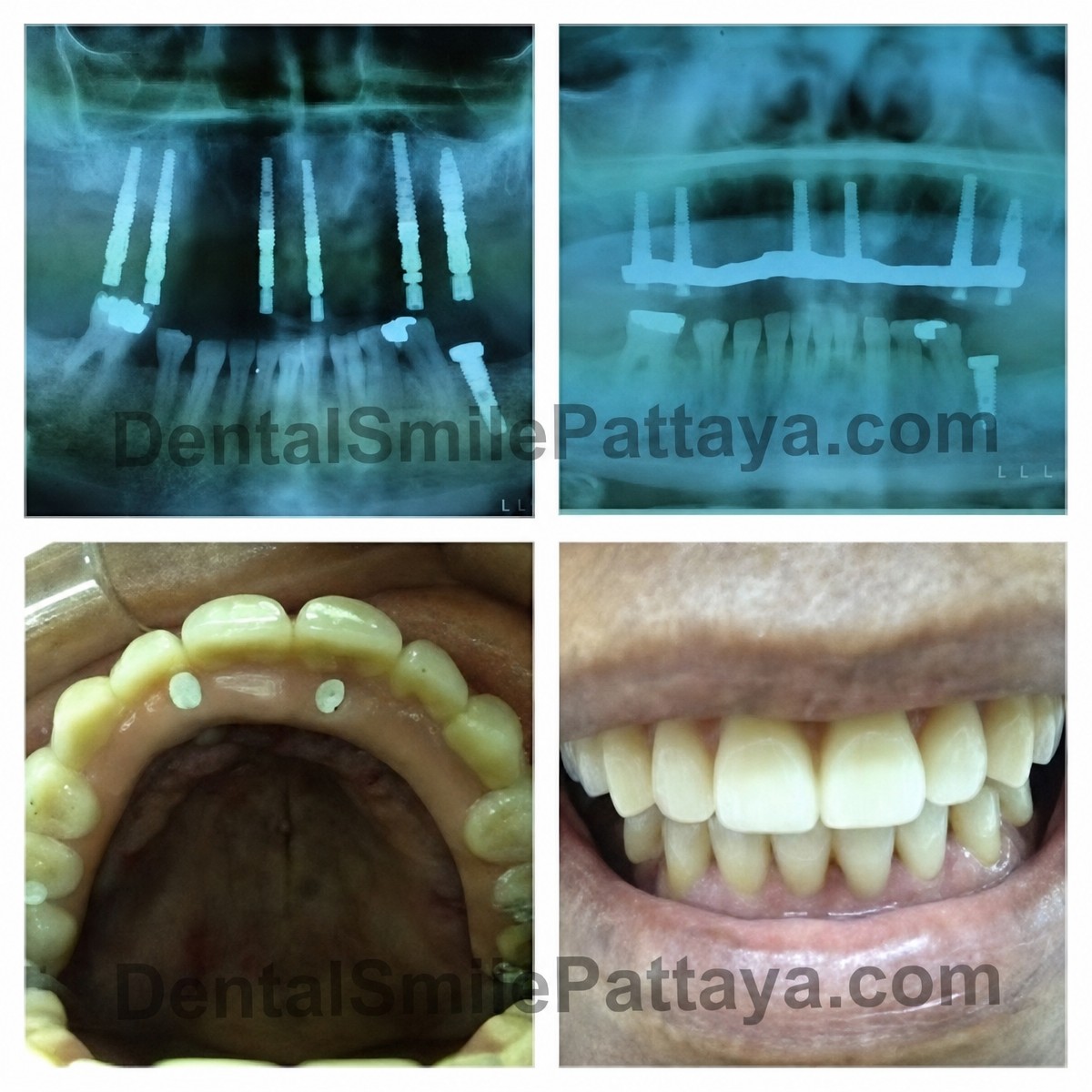 All-on-4 dental implants before and after results at Dental Smile Clinic - Pattaya Dentist