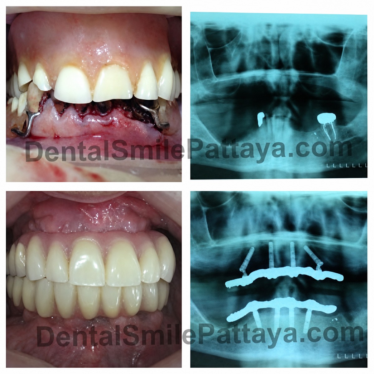 Before and after All-on-4 dental implants result at Dental Smile Clinic - Pattaya Dentist
