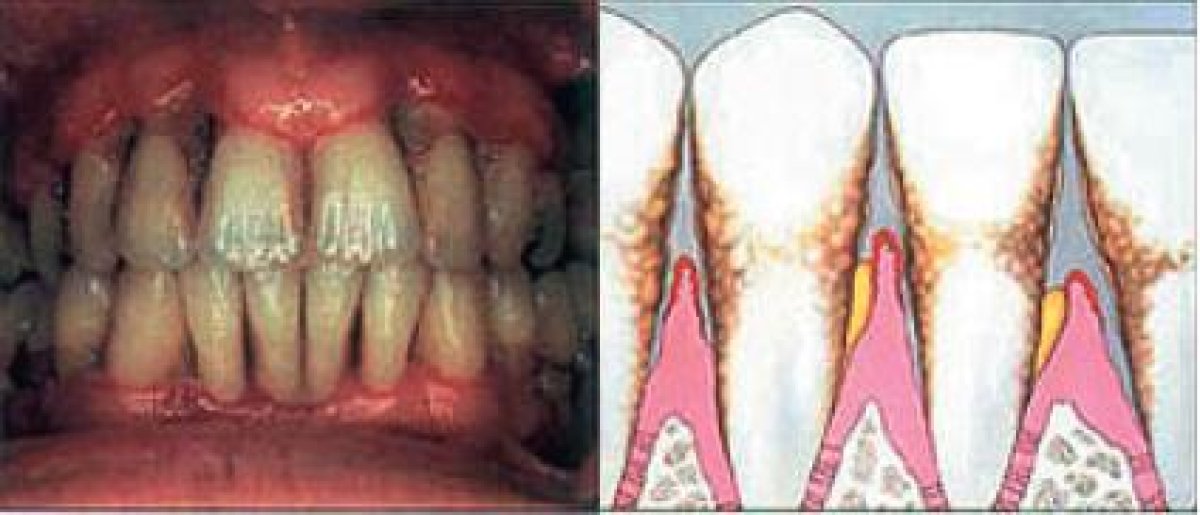 Результаты глубокой чистки зубов в Dental Smile Clinic - Pattaya Dentist, удаление налета