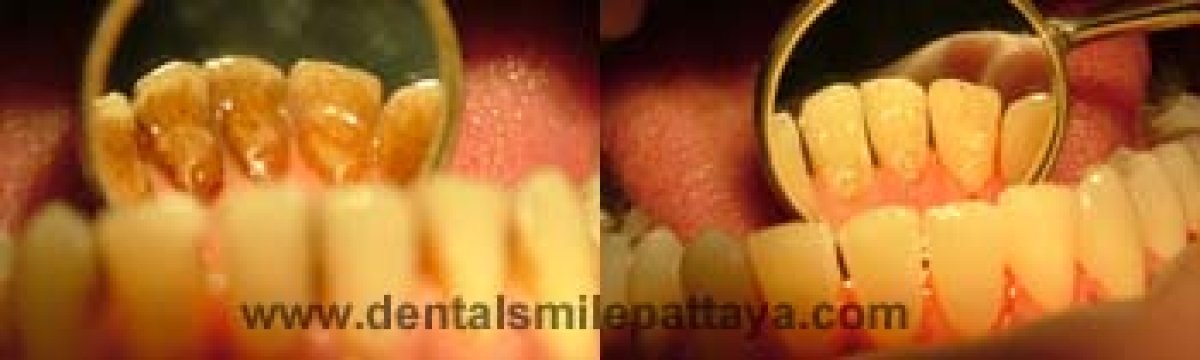 Resultados de blanqueamiento dental antes y después en Dental Smile Clinic - Pattaya Dentist