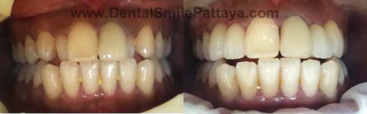 Résultats avant et après du blanchiment dentaire à Dental Smile Clinic - Pattaya Dentist, sourire éclatant