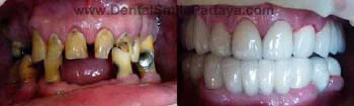 Resultados de blanqueamiento dental antes y después en Dental Smile Clinic - Pattaya Dentist