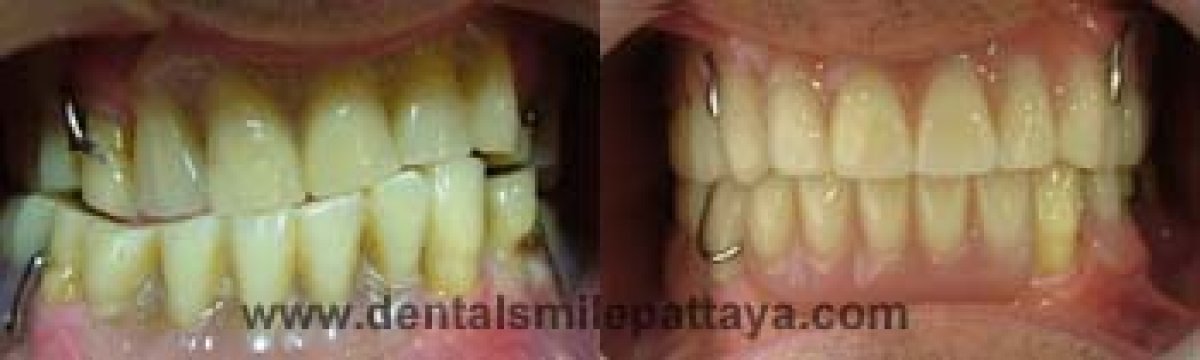 Résultats avant et après blanchiment des dents à Dental Smile Clinic - Pattaya Dentist, sourire éclatant