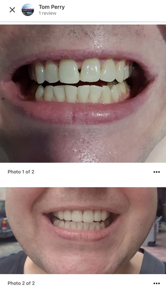 Resultado antes y después de carillas en Dental Smile Clinic - Pattaya Dentist, transformación de sonrisa