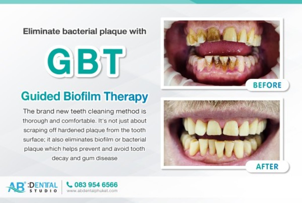 Результаты до и после глубокой чистки (GBT) в A.B. Dental Studio, удаление налета