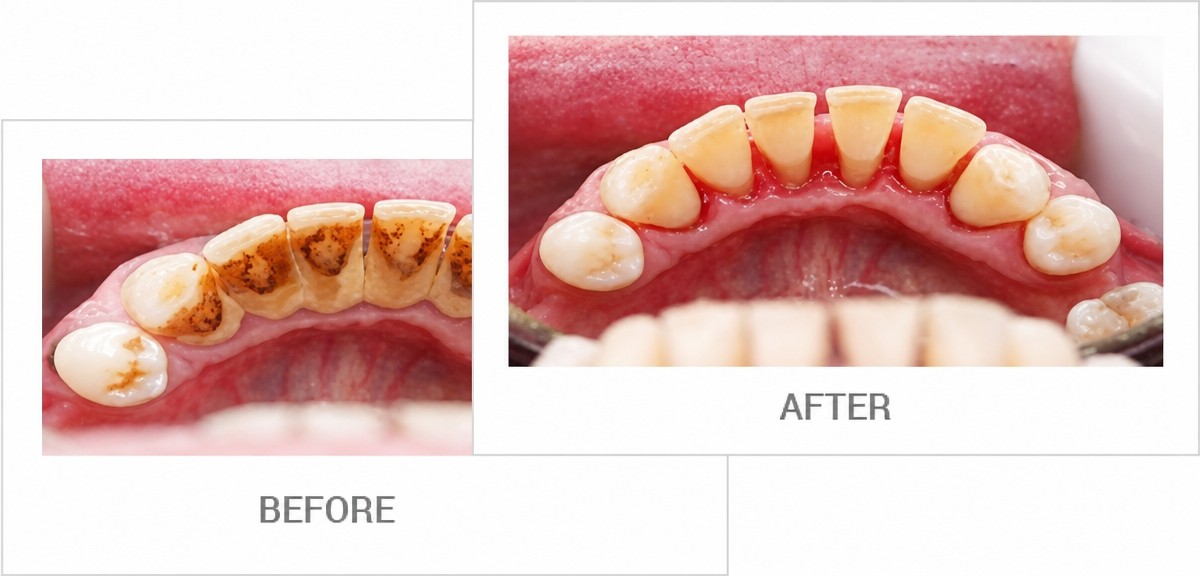 Результаты до и после глубокой чистки зубов (скейлинг) в A.B. Dental Studio
