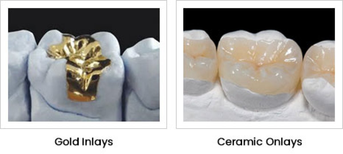 Comparaison des restaurations dentaires inlay or et onlay céramique chez A.B. Dental Studio résultats