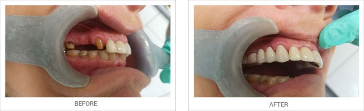Avant et après facettes dentaires chez A.B. Dental Studio – résultats restauration du sourire