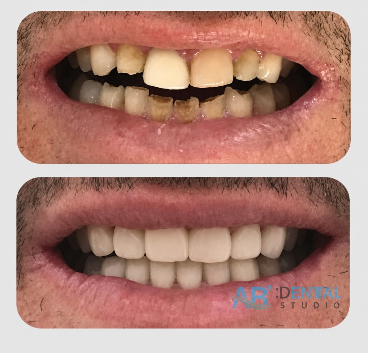 До и после установки виниров в A.B. Dental Studio – преображение улыбки с естественным результатом