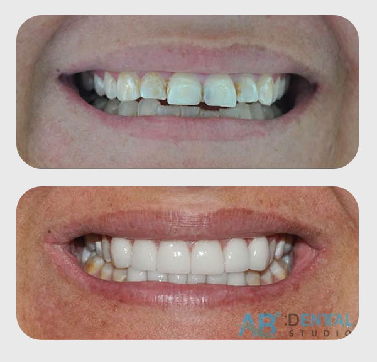 نتائج قبل وبعد الفينير في A.B. Dental Studio – ابتسامة أكثر بياضًا وتناسقًا