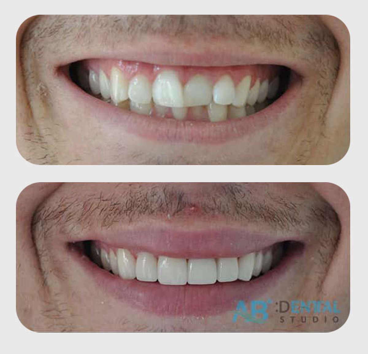До и после установки виниров в A.B. Dental Studio – естественное преображение улыбки