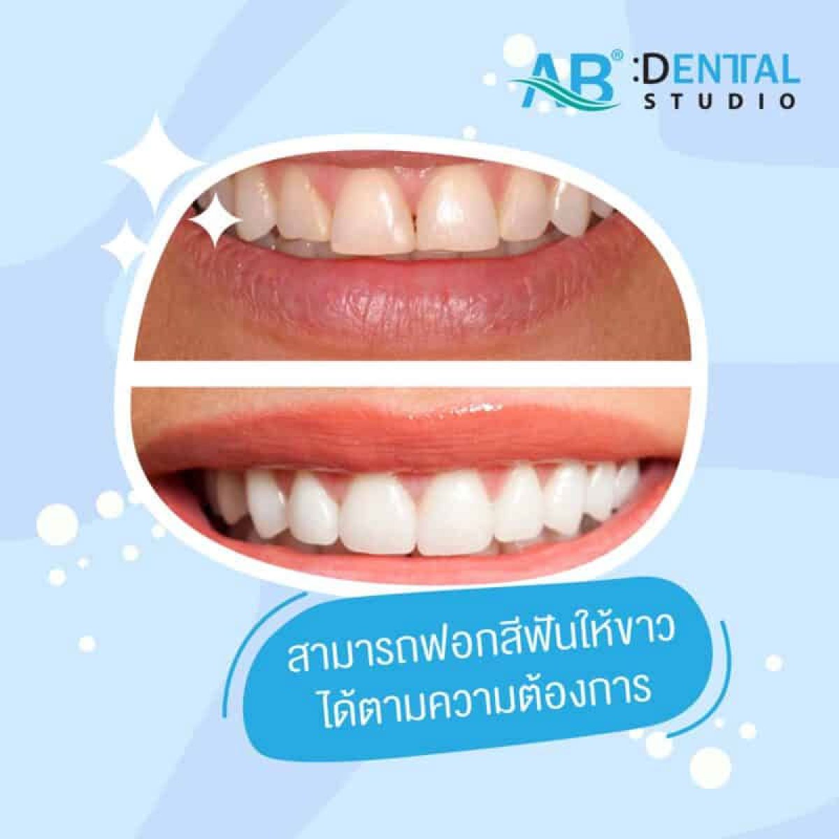 Before and after tooth whitening results at A.B. Dental Studio – visibly brighter smile