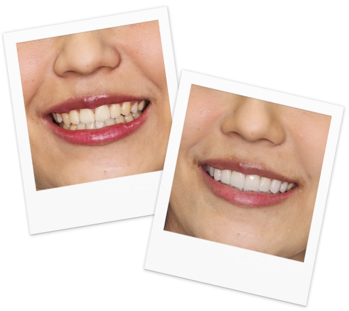 Before and after tooth whitening results at A.B. Dental Studio – visibly brighter smile