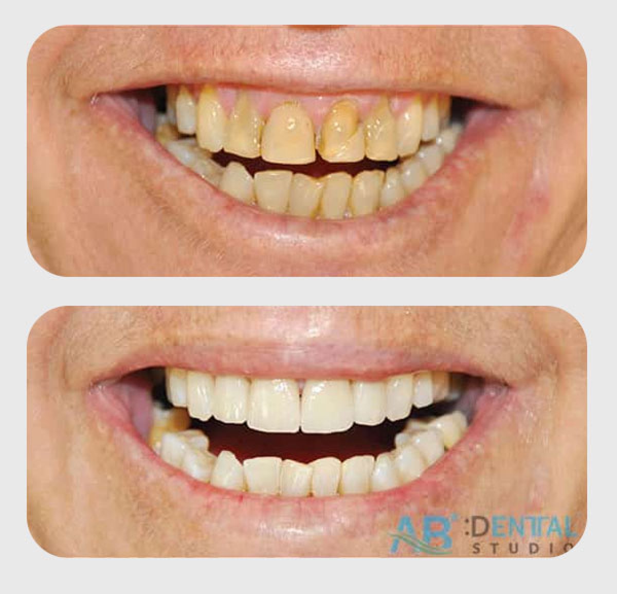 نتائج تبييض الأسنان قبل وبعد في A.B. Dental Studio – ابتسامة أكثر إشراقًا