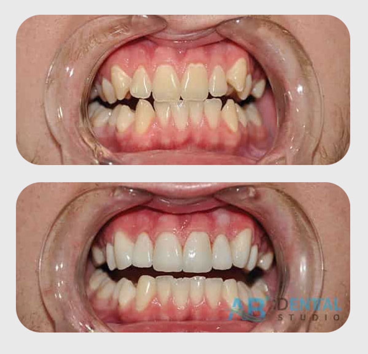 نتائج تبييض الأسنان قبل وبعد في A.B. Dental Studio – ابتسامة أكثر إشراقًا