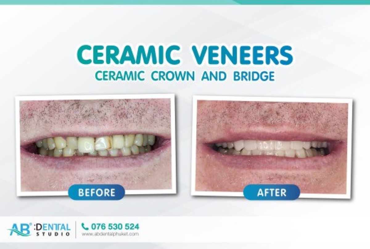 Before and after ceramic veneer results at A.B. Dental Studio – improved smile aesthetics