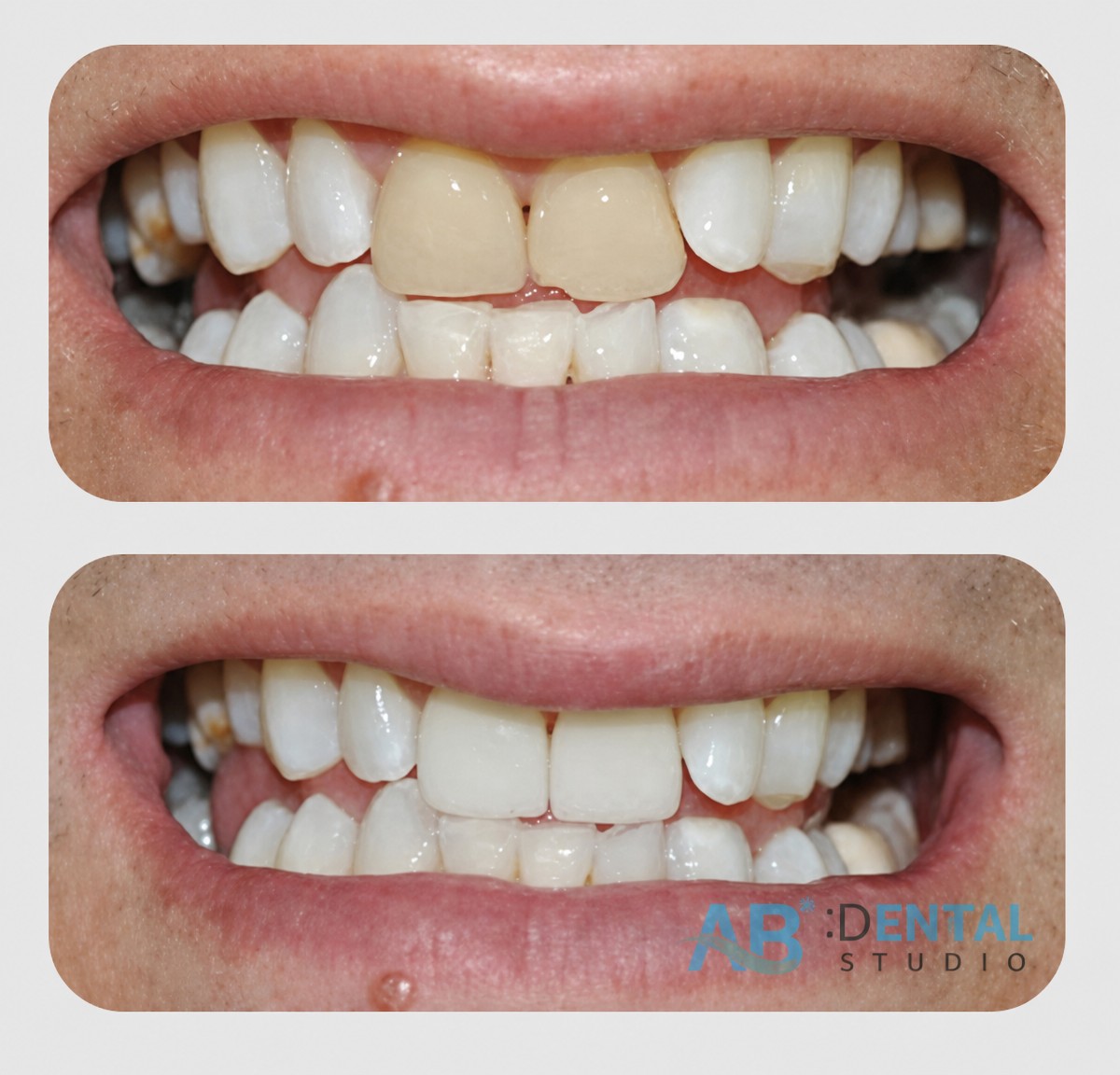 Porcelain veneer before and after results at A.B. Dental Studio – improved smile aesthetics