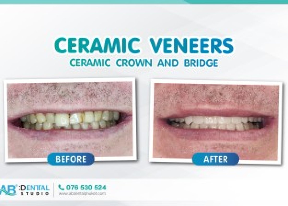 نتائج قبل وبعد قشور البورسلين في A.B. Dental Studio – تحسين جمالية الابتسامة