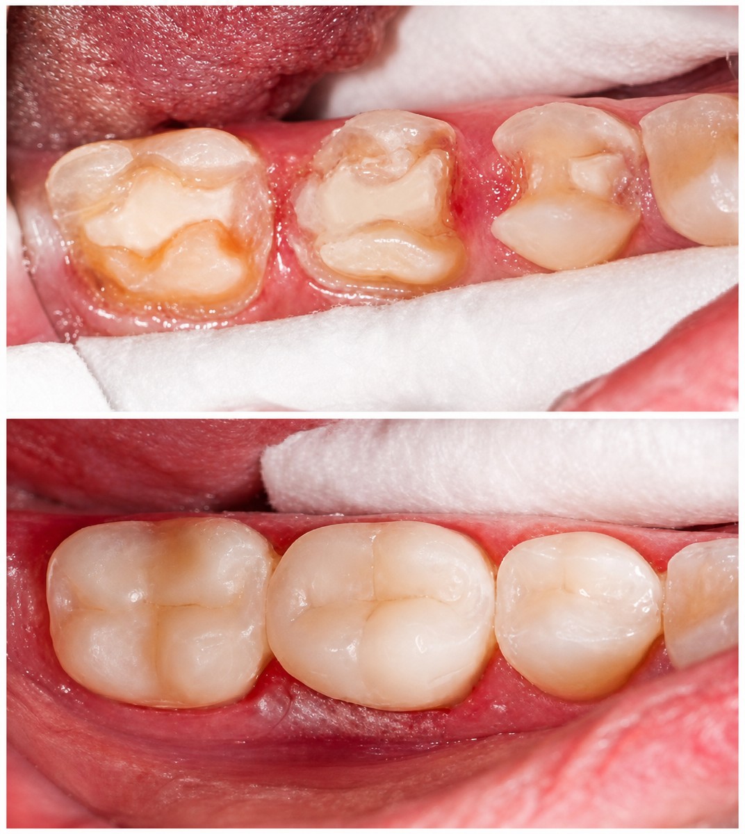 Résultats avant et après obturation composite à Pattaya Smile Dental Clinic, molaires restaurées