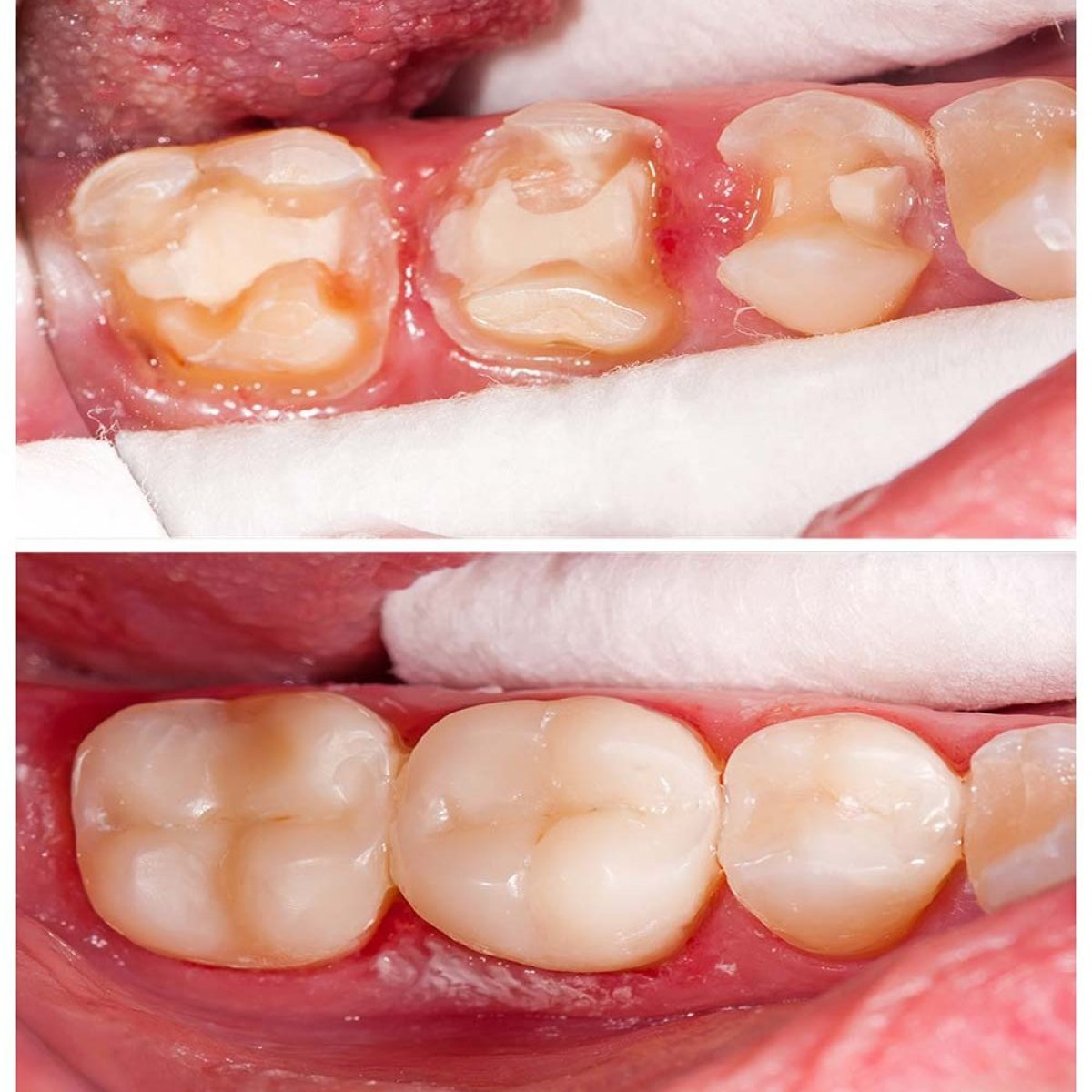 Результаты до и после композитной пломбы на молярах в Pattaya Smile Dental Clinic