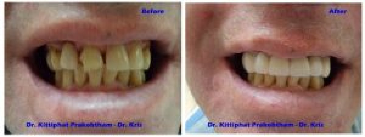 Before and after tooth whitening results at Pattaya Smile Dental Clinic, brighter smile achieved