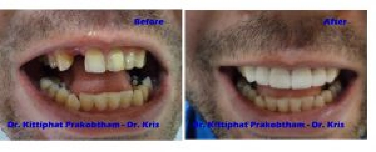 Результат до и после имплантации зубов в Pattaya Smile Dental Clinic для восстановления зубов