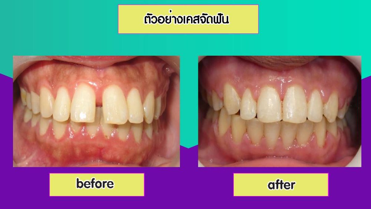 Résultats avant et après du blanchiment des dents à Pattaya Smile Dental Clinic, sourire éclatant