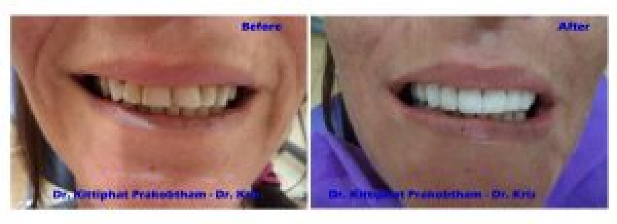 Результаты до и после отбеливания зубов в Pattaya Smile Dental Clinic, улыбка стала ярче