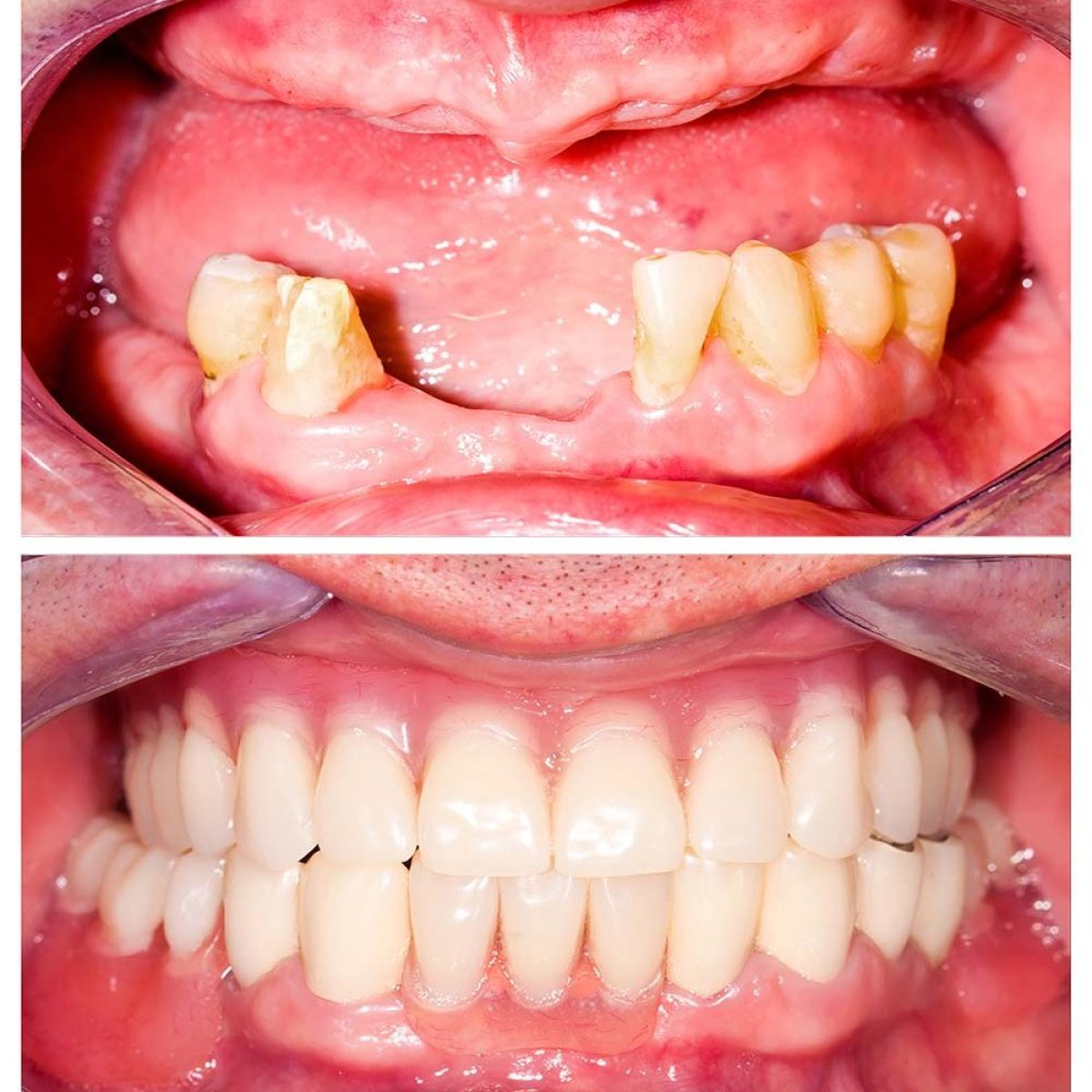 Before and after full dentures installation at Pattaya Smile Dental Clinic, smile restoration result