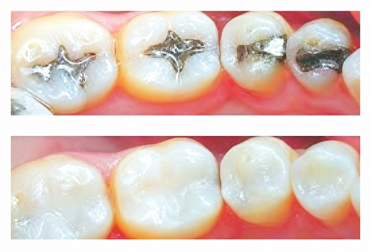 Before and after composite filling results at Phuket Dental Studio, natural tooth restoration