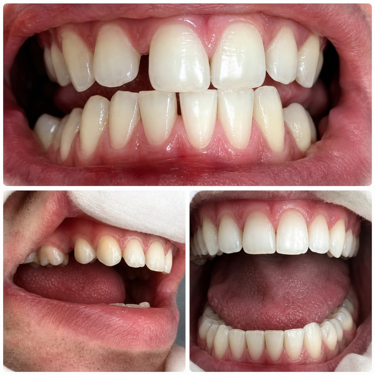 Before and after tooth whitening results at Phuket Dental Studio, visibly brighter smile