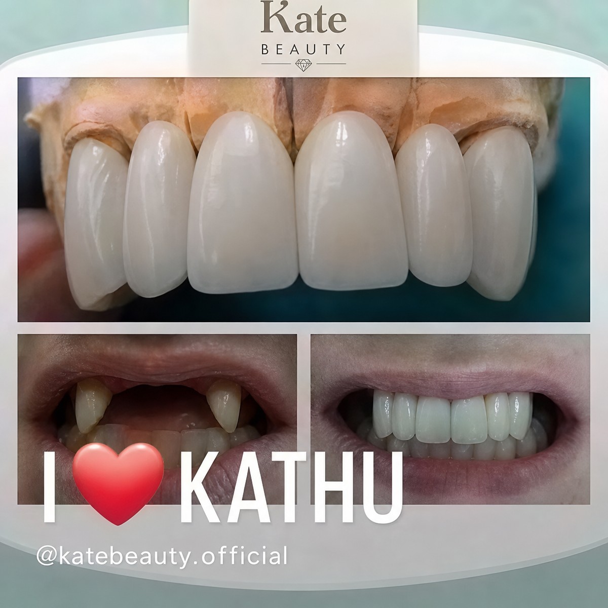Before and after dental implant results at Phuket Dental Studio, restored natural-looking teeth