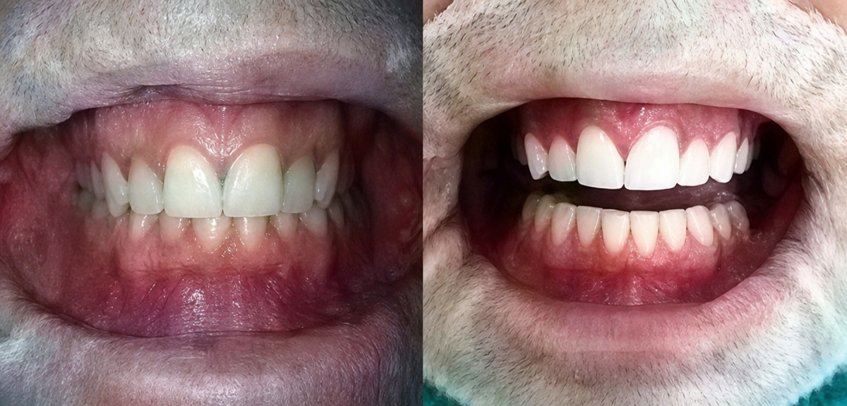 Before and after tooth whitening results at Phuket Dental Studio, visibly brighter smile