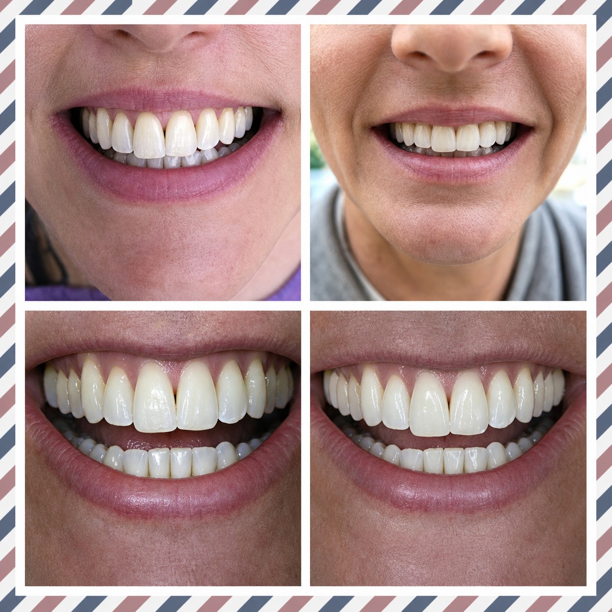 Before and after tooth whitening results at Phuket Dental Studio, visibly brighter smile