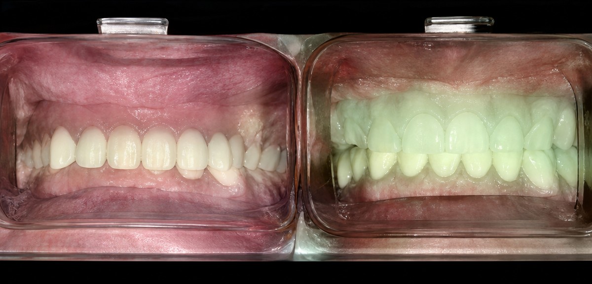 Результаты до и после чистки зубов (скейлинг) в Phuket Dental Studio, улучшена гигиена