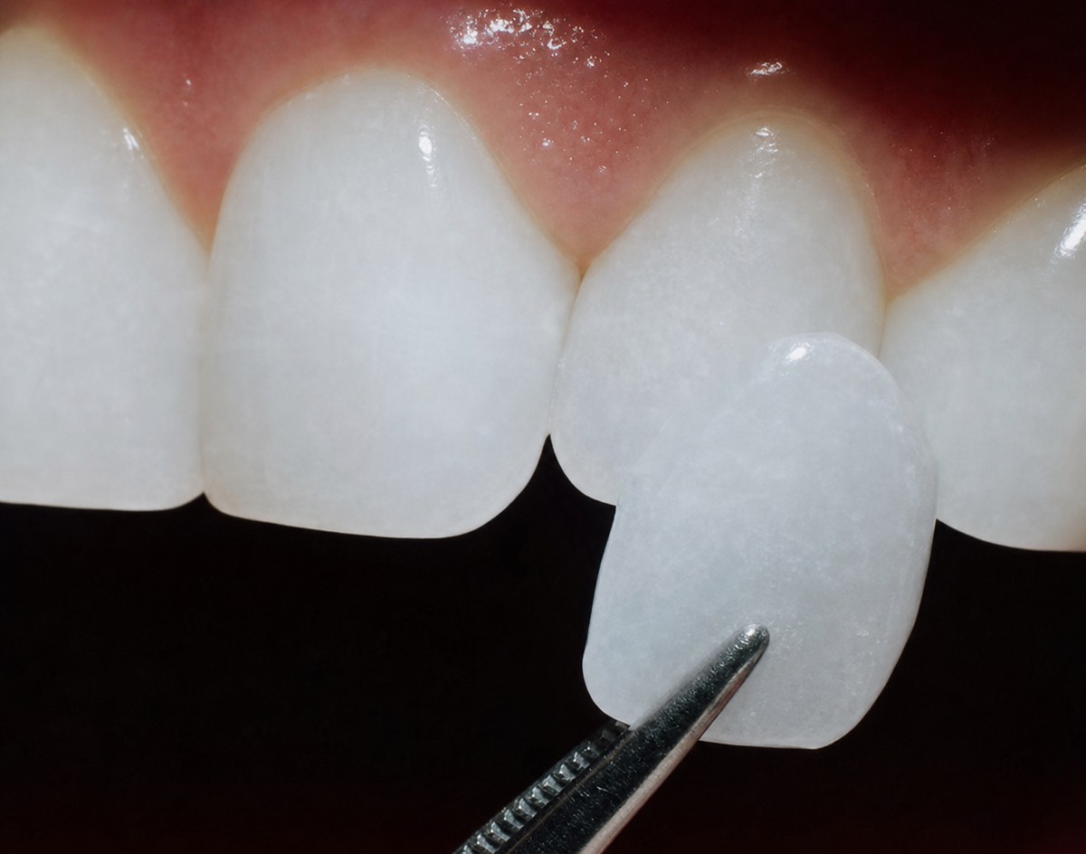Dental bonding result at Phuket Dental Studio, improved tooth appearance and smile aesthetics