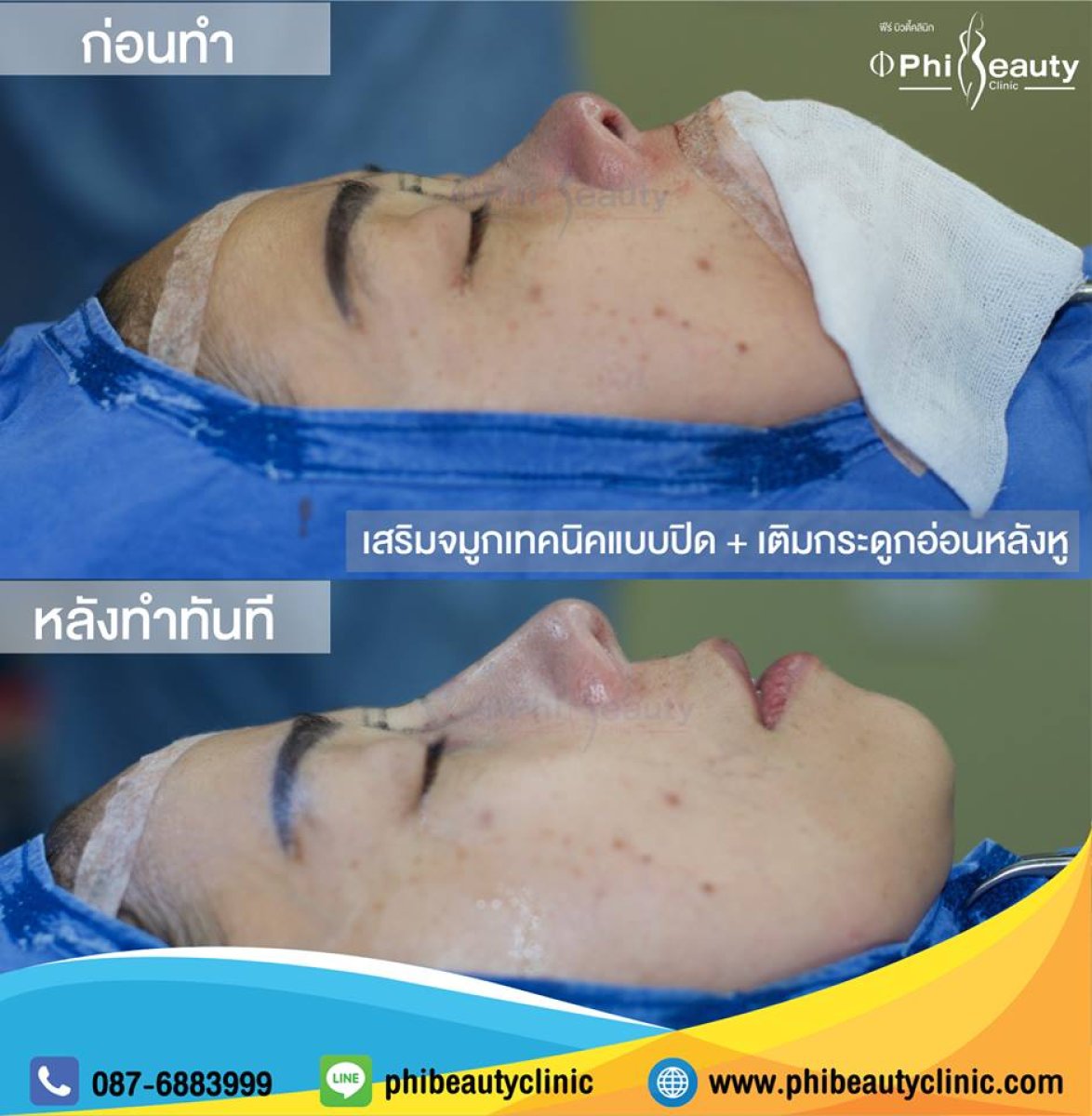 Результаты ринопластики до и после в Phi Beauty Clinic, улучшенная форма носа и профиль