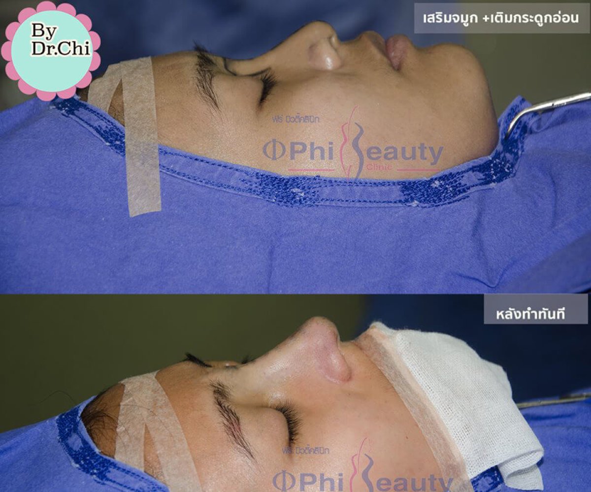 Результаты ринопластики до и после в Phi Beauty Clinic, улучшенная форма носа