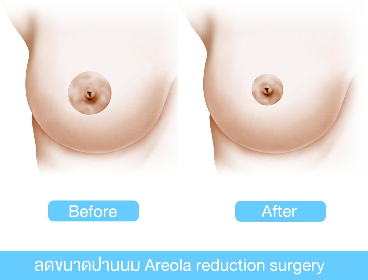Résultats avant/après réduction de l'aréole à la Phi Beauty Clinic – aréole réduite