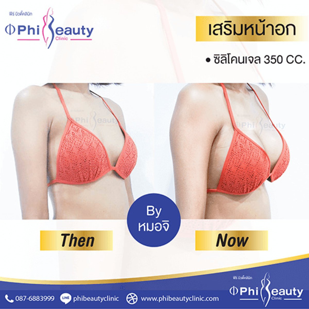 Before and after breast augmentation with saline implants at Phi Beauty Clinic, visible results