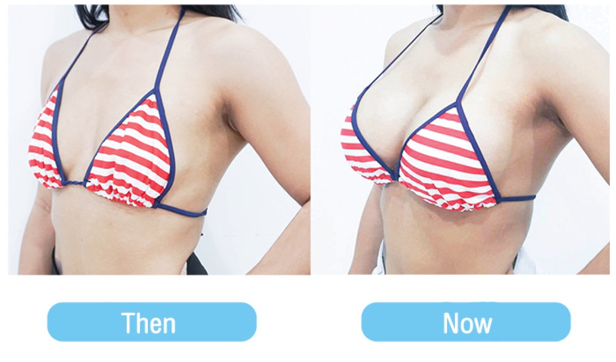 Resultados antes y después de aumento de senos en Phi Beauty Clinic, mayor volumen mamario