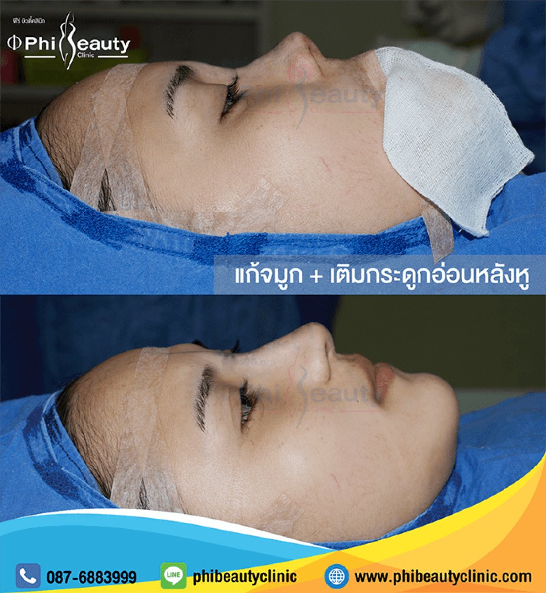 Antes y después de la eliminación de giba nasal en Phi Beauty Clinic, perfil mejorado