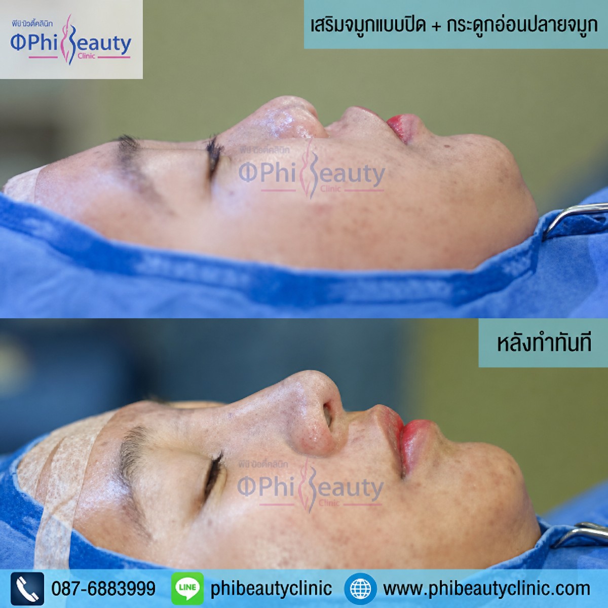 Antes y después de la eliminación de giba nasal en Phi Beauty Clinic, perfil mejorado