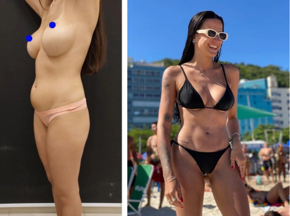 Avant et après augmentation mammaire chez Plastic Rio, forme et contour des seins améliorés